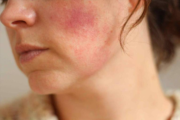 Dấu hiệu nhận biết da mặt bị nhiễm corticoid nặng