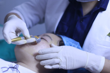 Lăn kim là gì - Lăn kim có tự thực hiện tại nhà được không