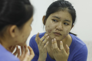 Mụn là gì - Các loại mụn và nguyên nhân gây nổi mụn trên da